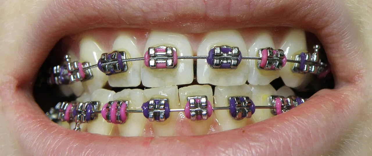Smiling patient with clear ceramic braces